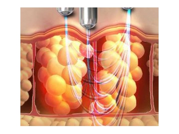 جهاز تجميل Elight Yag Laser RF