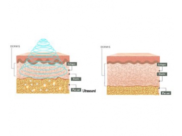 جهاز تجميل Cavitation Vacuum RF Laser